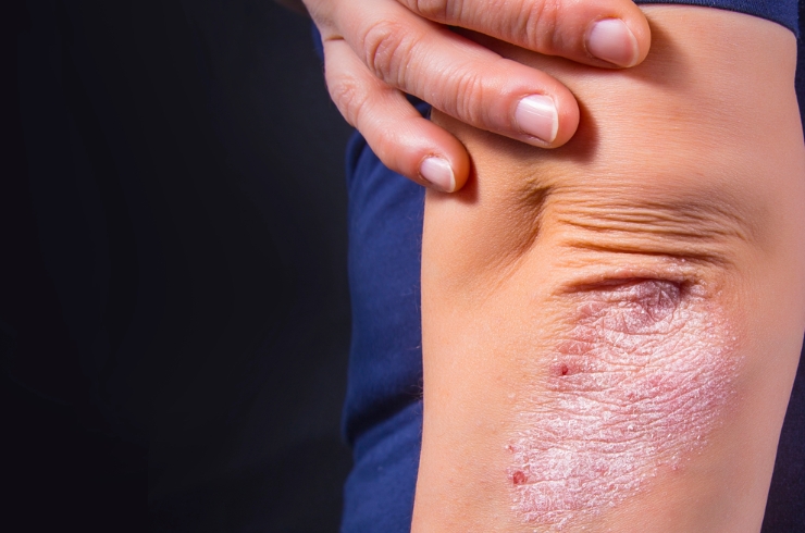 Psoriasis.jpg